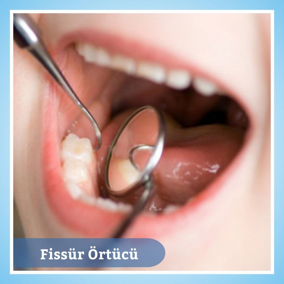 Çocukları 6 ayda bir diş hekimine götürün Çocukları 6 ayda bir diş hekimine götürün