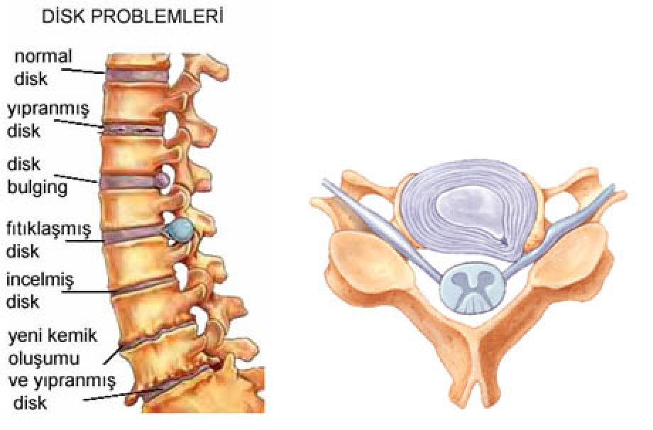 Bel Ağrısı İnsanı Bezdirir