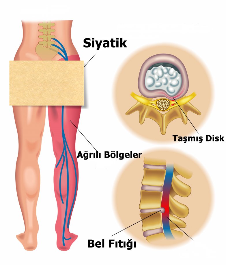 Bel ve Boyun Rahatsızlıklarında Koruyucu Sağlık