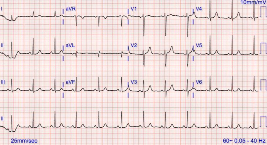 Ekg